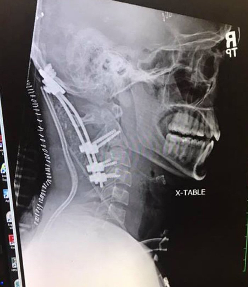 Illustration for article titled Este joven sobrevivió a una lesión espinal tan letal que se la conoce como decapitación interna